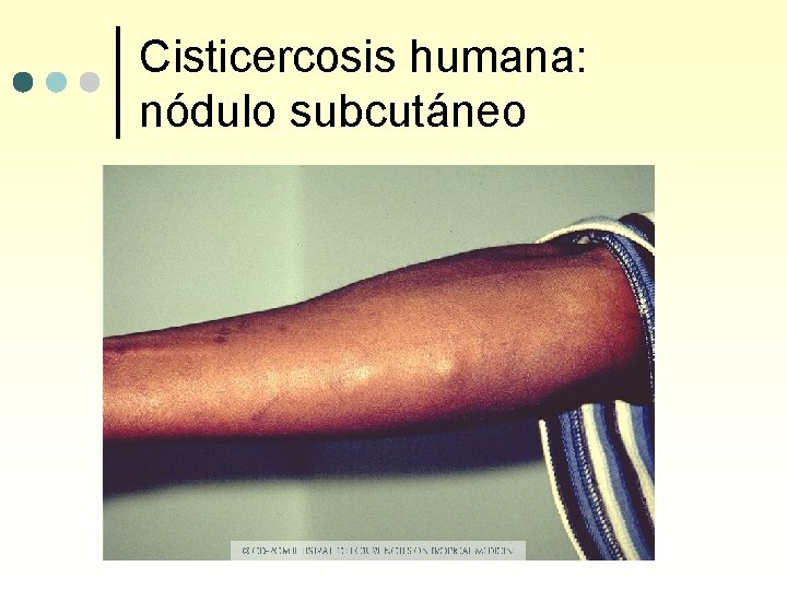 Cisticercosis humana: nódulo subcutáneo 