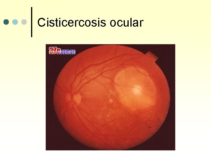 Cisticercosis ocular 