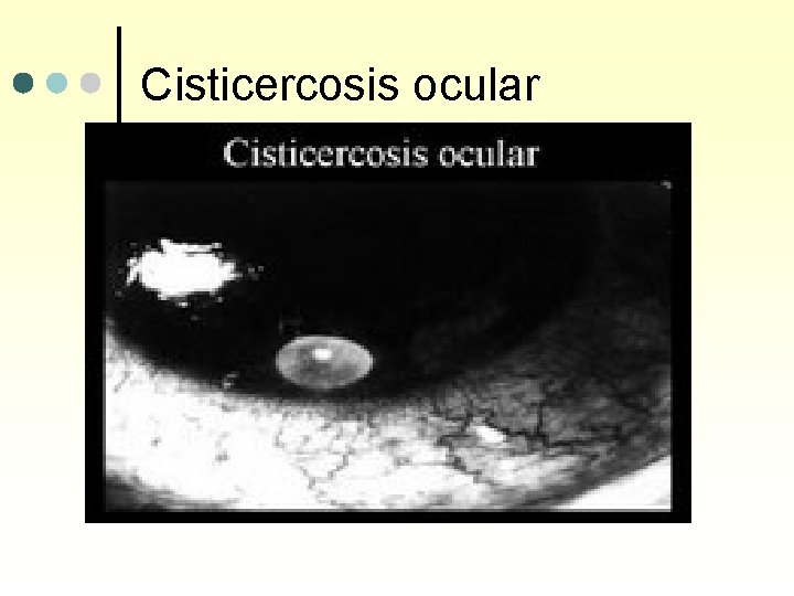 Cisticercosis ocular 