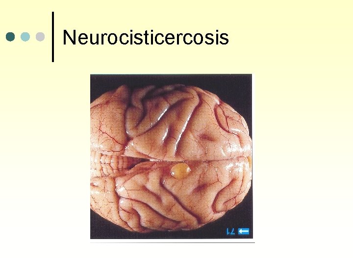 Neurocisticercosis 