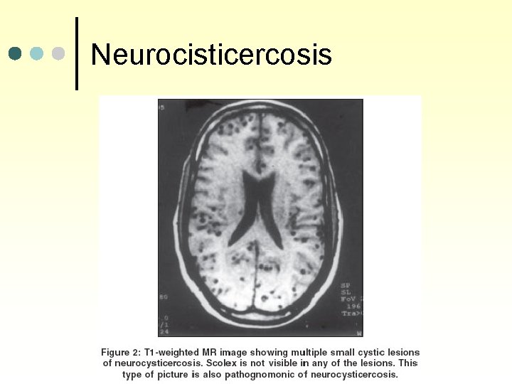 Neurocisticercosis 