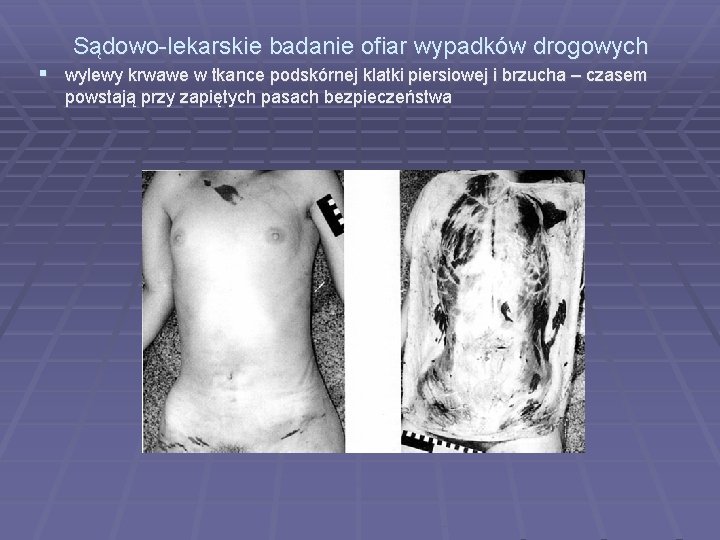 Sądowo-lekarskie badanie ofiar wypadków drogowych wylewy krwawe w tkance podskórnej klatki piersiowej i brzucha Sądowo-lekarskie badanie ofiar wypadków drogowych wylewy krwawe w tkance podskórnej klatki piersiowej i brzucha