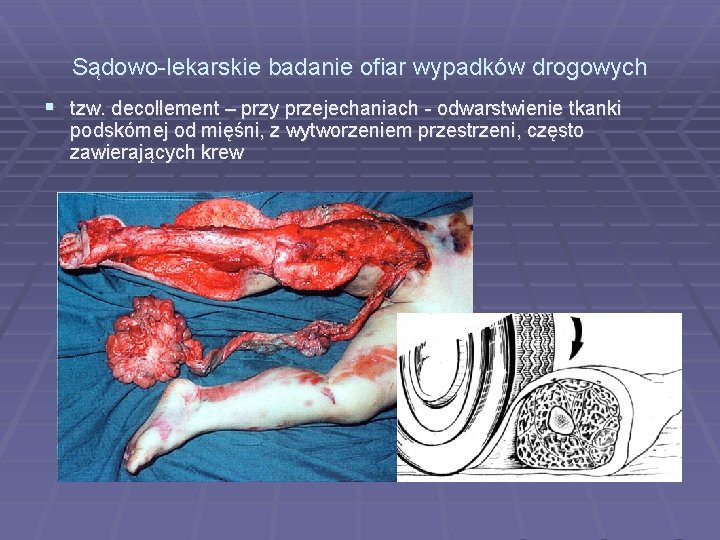 Sądowo-lekarskie badanie ofiar wypadków drogowych tzw. decollement – przy przejechaniach - odwarstwienie tkanki podskórnej Sądowo-lekarskie badanie ofiar wypadków drogowych tzw. decollement – przy przejechaniach - odwarstwienie tkanki podskórnej