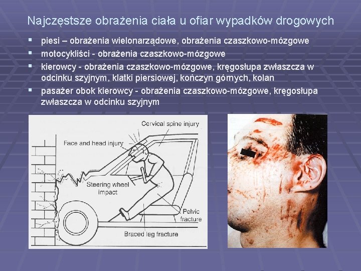 Najczęstsze obrażenia ciała u ofiar wypadków drogowych piesi – obrażenia wielonarządowe, obrażenia czaszkowo-mózgowe motocykliści