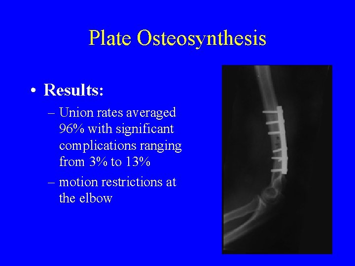 Plate Osteosynthesis • Results: – Union rates averaged 96% with significant complications ranging from