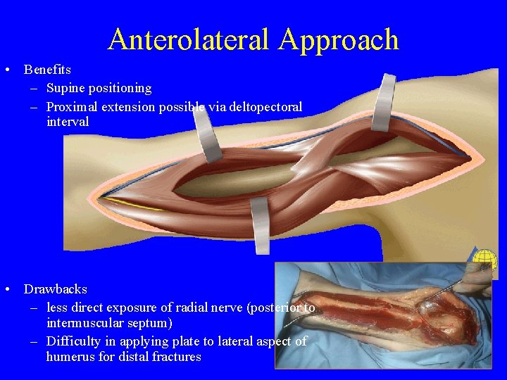 Anterolateral Approach • Benefits – Supine positioning – Proximal extension possible via deltopectoral interval