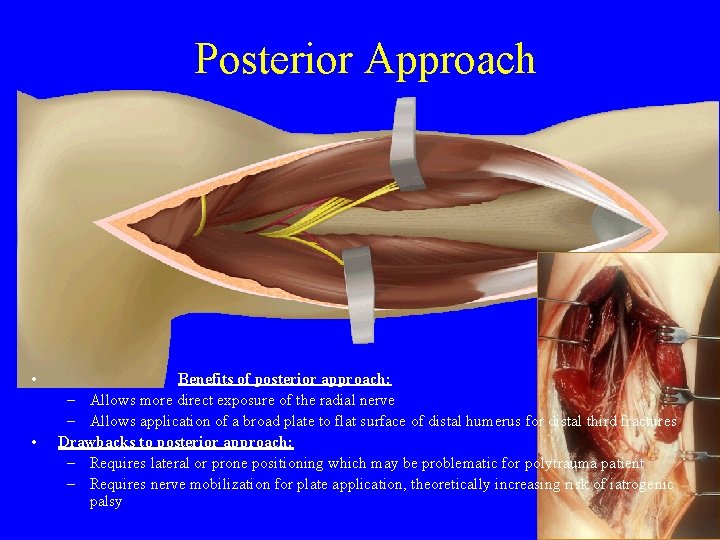 Posterior Approach • • Benefits of posterior approach: – Allows more direct exposure of