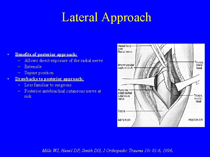 Lateral Approach • • Benefits of posterior approach: – Allows direct exposure of the