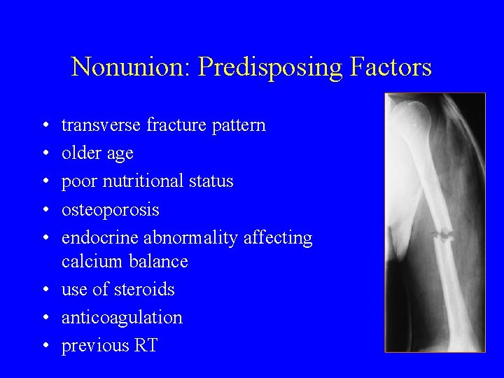 Nonunion: Predisposing Factors • • • transverse fracture pattern older age poor nutritional status