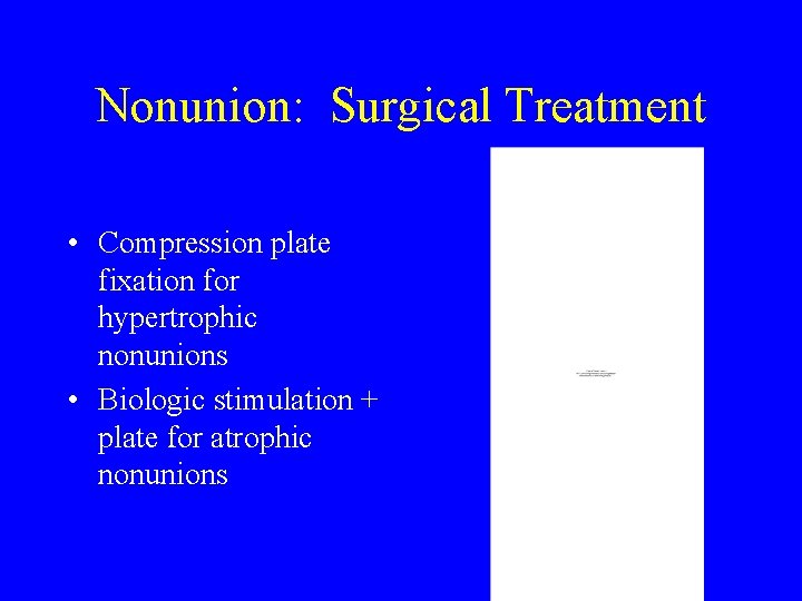 Nonunion: Surgical Treatment • Compression plate fixation for hypertrophic nonunions • Biologic stimulation +