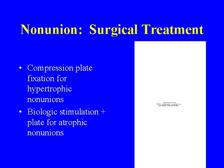 Nonunion: Surgical Treatment • Compression plate fixation for hypertrophic nonunions • Biologic stimulation +