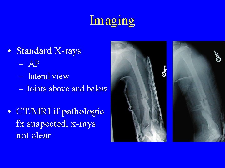 Imaging • Standard X-rays – AP – lateral view – Joints above and below