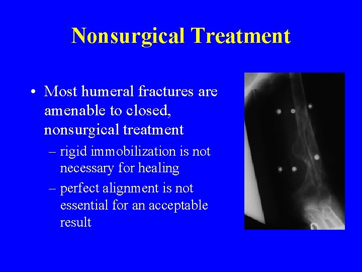 Nonsurgical Treatment • Most humeral fractures are amenable to closed, nonsurgical treatment – rigid
