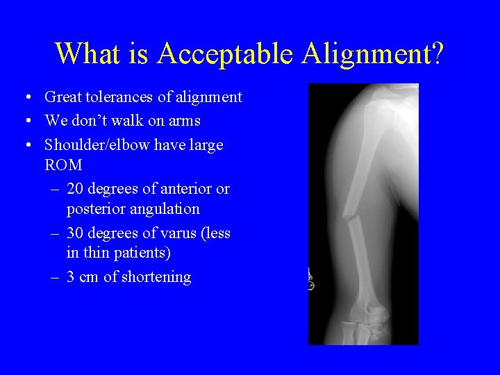 What is Acceptable Alignment? • Great tolerances of alignment • We don’t walk on