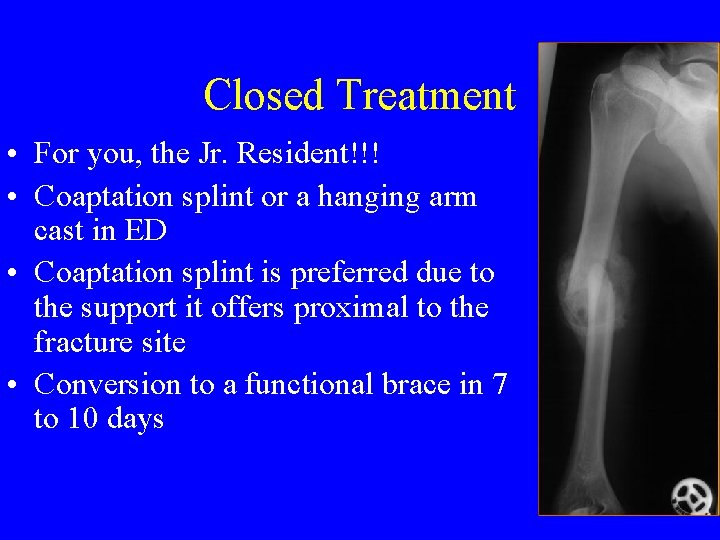 Closed Treatment • For you, the Jr. Resident!!! • Coaptation splint or a hanging