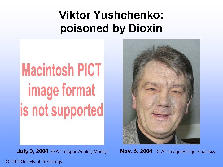 Viktor Yushchenko: poisoned by Dioxin July 3, 2004 © AP Images/Anatoly Medzyk © 2008