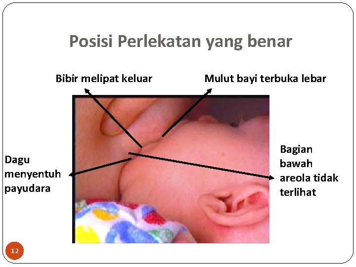 Posisi Perlekatan yang benar Bibir melipat keluar Dagu menyentuh payudara 12 Mulut bayi terbuka