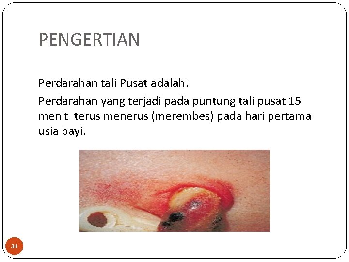 PENGERTIAN Perdarahan tali Pusat adalah: Perdarahan yang terjadi pada puntung tali pusat 15 menit