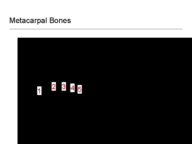 Metacarpal Bones 1 2 3 4 5 Metacarpals are identify as 1 st through