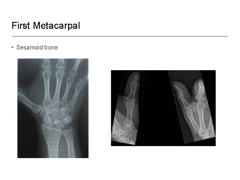 First Metacarpal • Sesamoid bone 