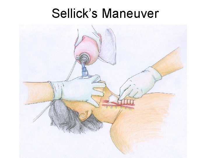 Sellick’s Maneuver 