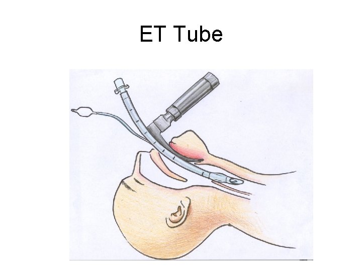 ET Tube ET Tube