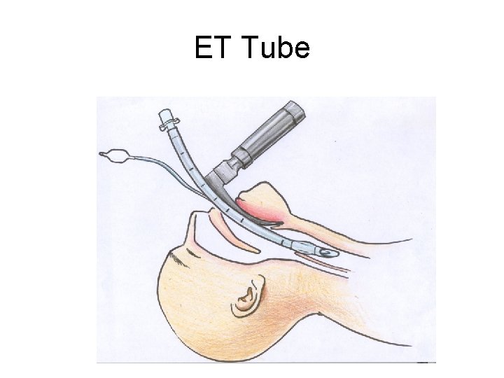 ET Tube 