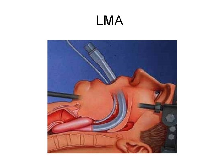 LMA 