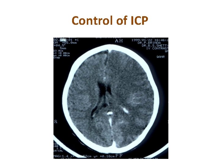 Control of ICP 