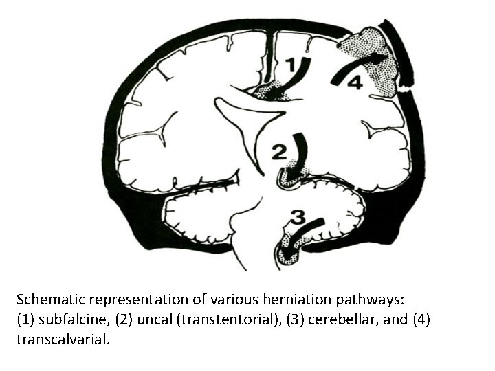 Schematic representation of various herniation pathways: (1) subfalcine, (2) uncal (transtentorial), (3) cerebellar, and