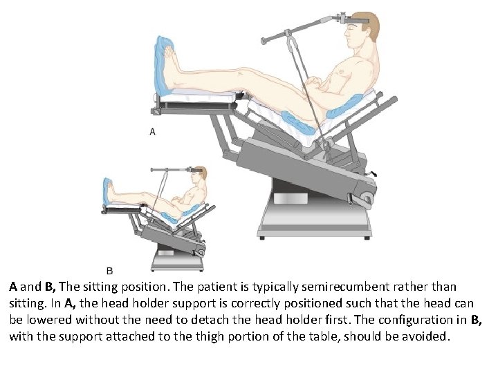 A and B, The sitting position. The patient is typically semirecumbent rather than sitting.