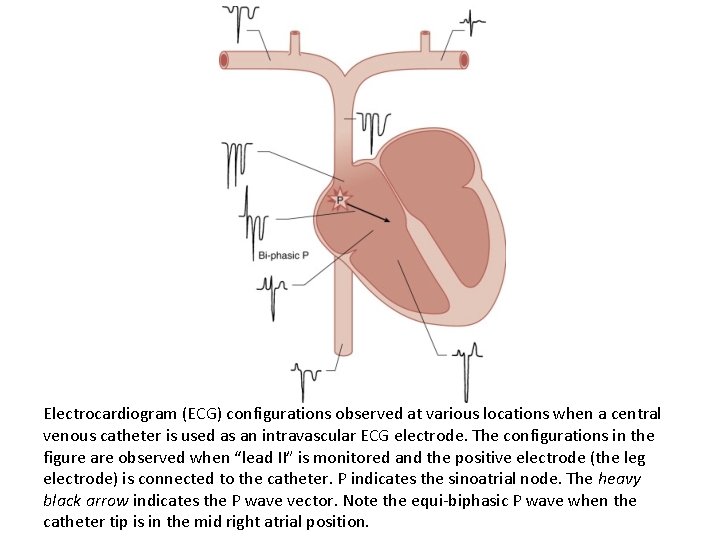 Electrocardiogram (ECG) configurations observed at various locations when a central venous catheter is used