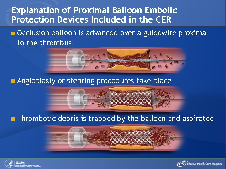 Explanation of Proximal Balloon Embolic Protection Devices Included in the CER < Occlusion balloon