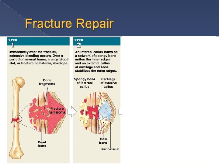 Fracture Repair 