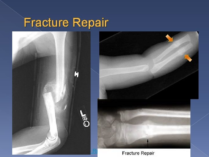 Fracture Repair Animation 