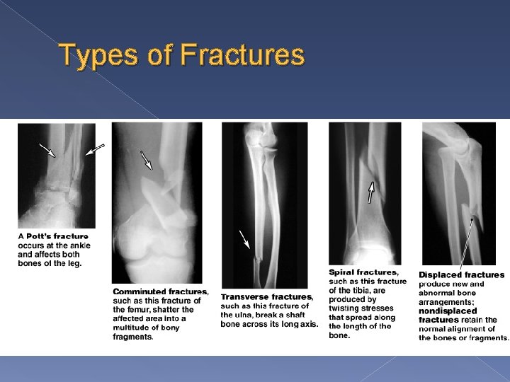 Types of Fractures 