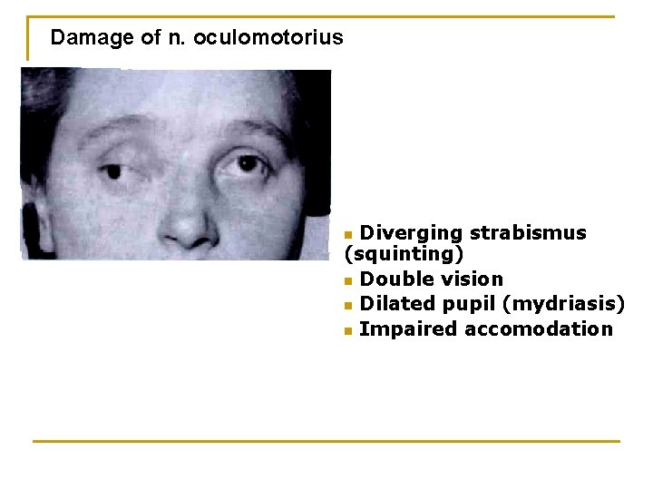 Damage of n. oculomotorius Diverging strabismus (squinting) n Double vision n Dilated pupil (mydriasis)