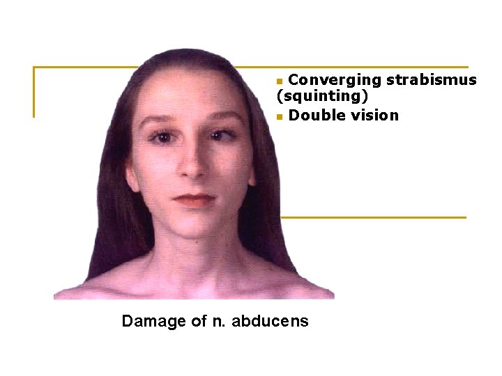 Converging strabismus (squinting) n Double vision n Damage of n. abducens 