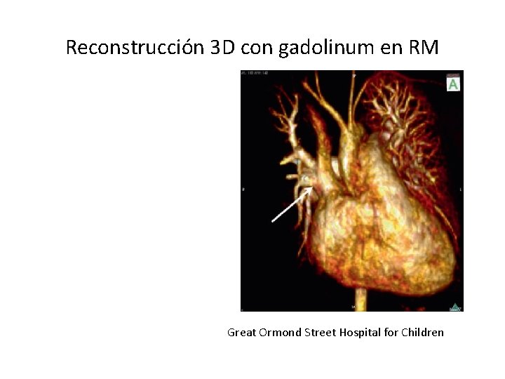Reconstrucción 3 D con gadolinum en RM Great Ormond Street Hospital for Children 