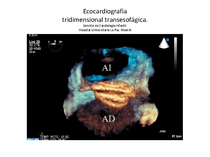 Ecocardiografía tridimensional transesofágica. Servicio de Cardiología Infantil. Hospital Universitario La Paz. Madrid 