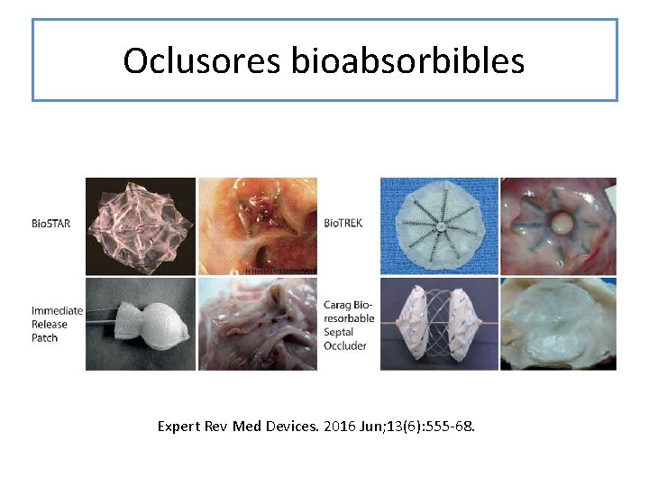 Oclusores bioabsorbibles Expert Rev Med Devices. 2016 Jun; 13(6): 555 -68. 
