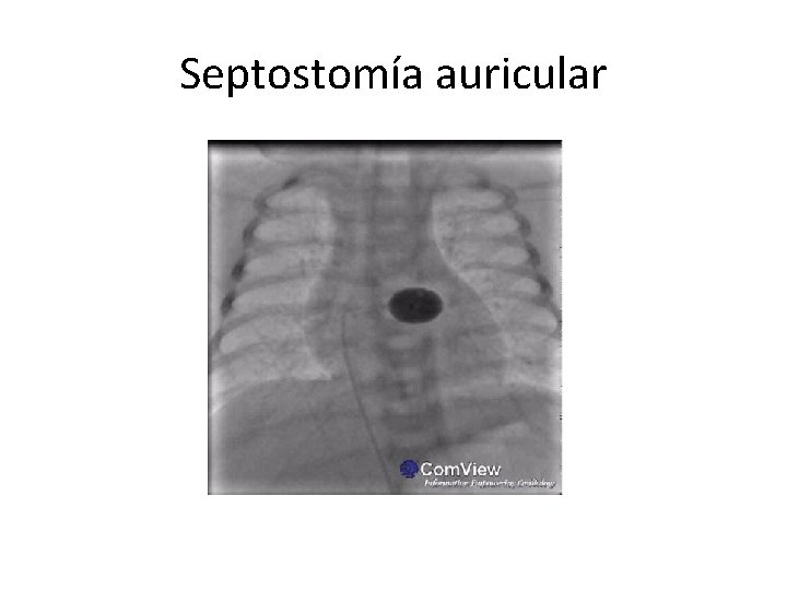 Septostomía auricular 