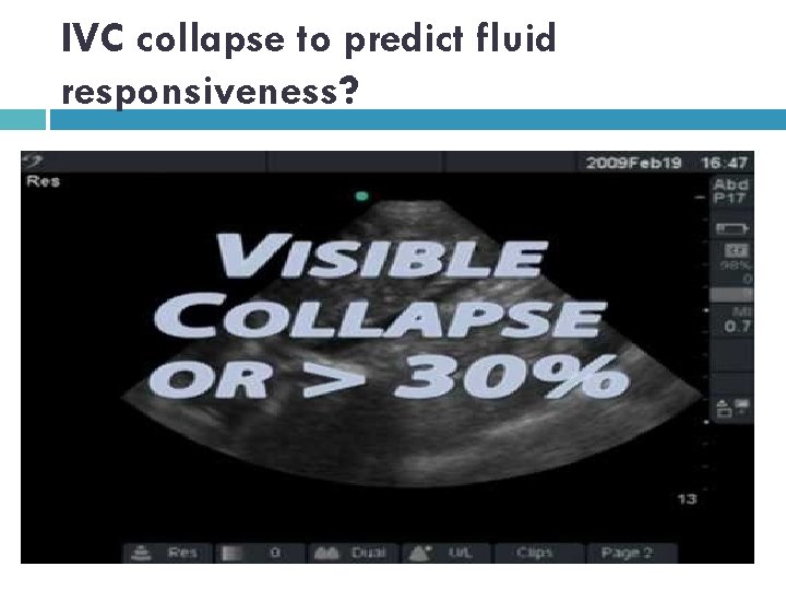 IVC collapse to predict fluid responsiveness? 