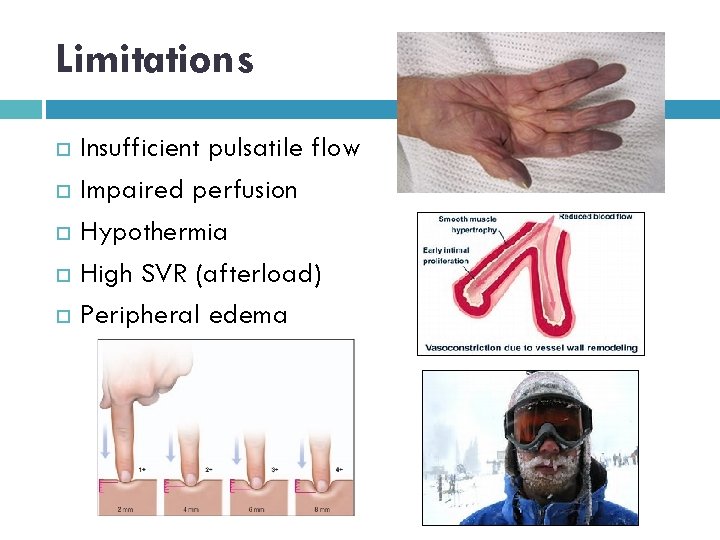 Limitations Insufficient pulsatile flow Impaired perfusion Hypothermia High SVR (afterload) Peripheral edema 
