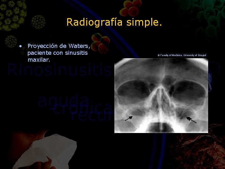 Radiografía simple. • Proyección de Waters, paciente con sinusitis maxilar. © Faculty of Medicine,