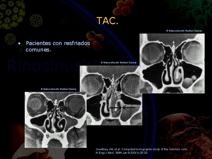 TAC. © Massachusetts Medical Society. • Pacientes con resfriados comunes. © Massachusetts Medical Society.