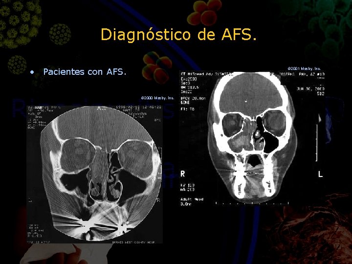 Diagnóstico de AFS. • Pacientes con AFS. © 2001 Mosby, Inc. © 2000 Mosby,