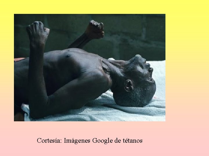 Cortesía: Imágenes Google de tétanos Cortesía: Imágenes Google de tétanos