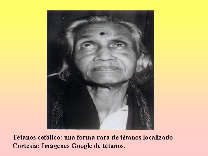 Tétanos cefálico: una forma rara de tétanos localizado Cortesía: Imágenes Google de tétanos. Tétanos cefálico: una forma rara de tétanos localizado Cortesía: Imágenes Google de tétanos.