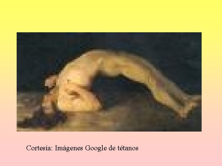 Cortesía: Imágenes Google de tétanos Cortesía: Imágenes Google de tétanos